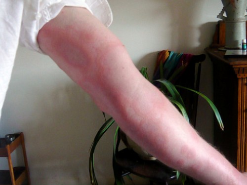 Depilación durante un caso de alergia en la piel